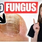 Toenail Fungus Treatment: Nail Fungus Solutions That Work