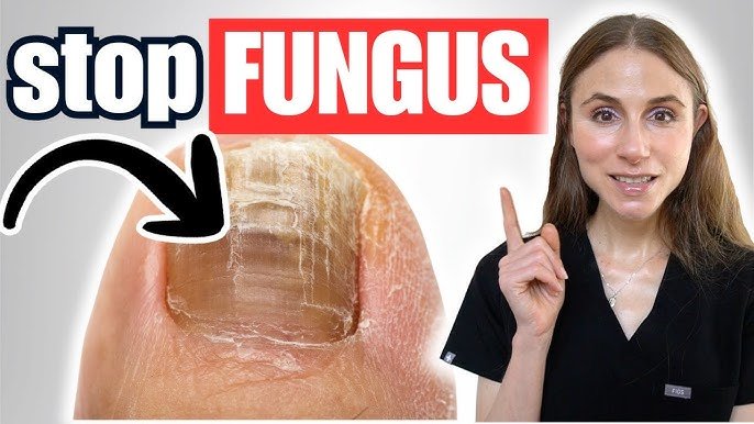 Toenail Fungus Treatment: Nail Fungus Solutions That Work